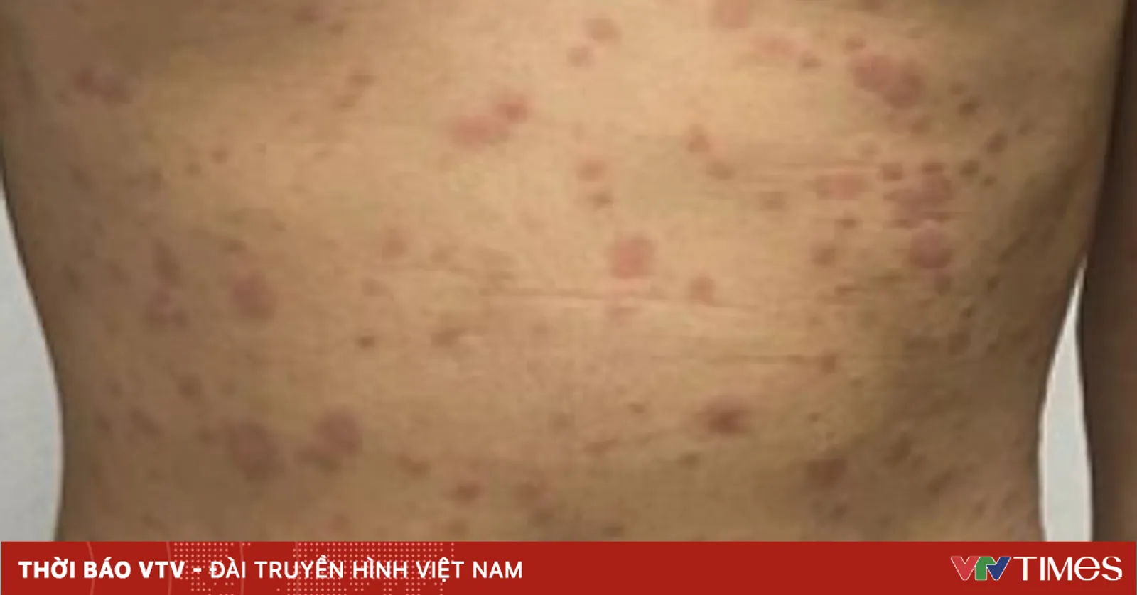 Bokep Viral Indo Interaksi ngentot tak memakai perlindungan meraih menyebabkan ditemukannya infeksi ganda sifilis dan HIV.